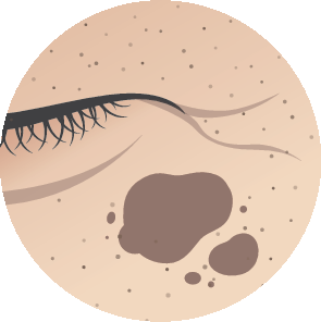 Mole, Melasma
