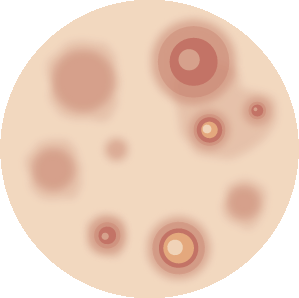 Syringoma, Milium