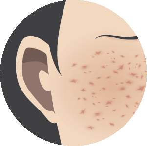 Scar (Burn, Pore, Acne)